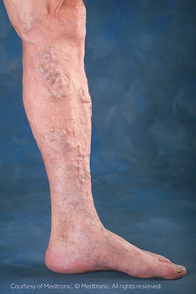 Chronic Venous Insufficiency & Varicose Veins - Elite Cardiovascular Group