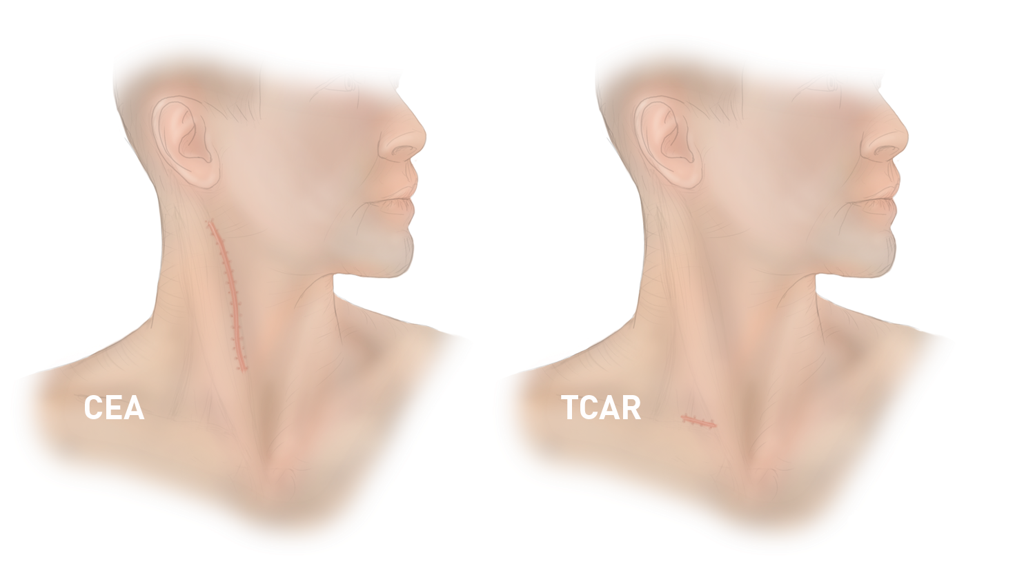 Elite Heart Surgeons TCAR vs CEA Scars